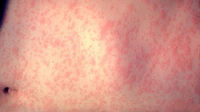 640px-Morbillivirus_measles_infection